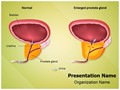 Professional Benign Prostatic Hyperplasia Editable PowerPoint Template