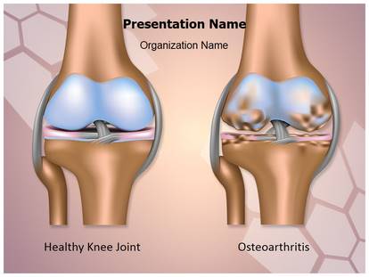 osteoarthritis of knee case presentation ppt