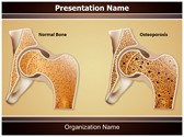 Osteopathy Osteoporosis PowerPoint Templates